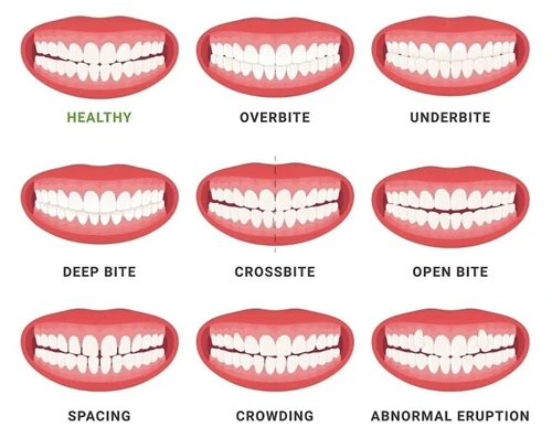 Intraoral Scanner + 3D Printed Clear Aligners in Orthodontics: The Digital Re...